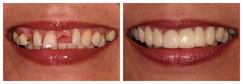 crown and bridge restorative dentistry