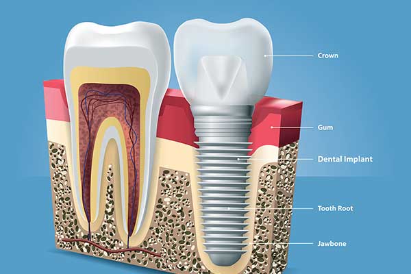 dental implants