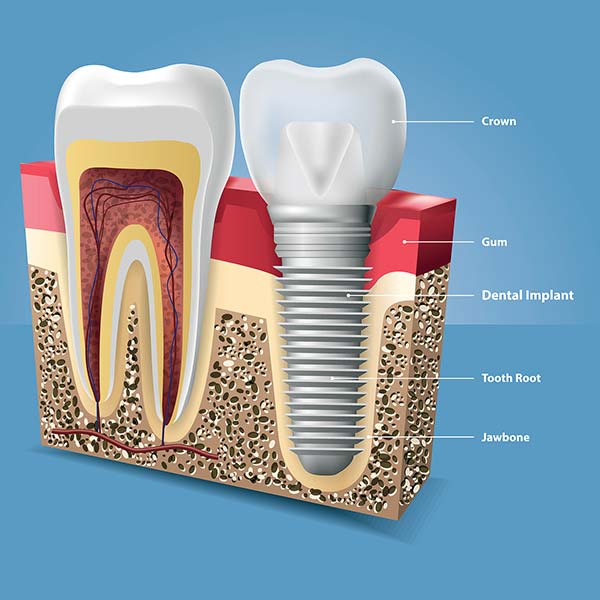 dental implant illustration