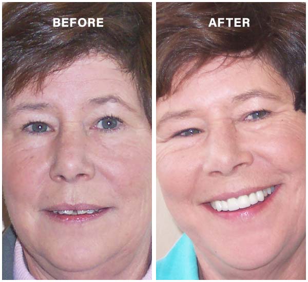 before and after cosmetic dentistry