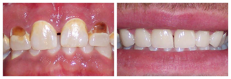 veneers on teeth