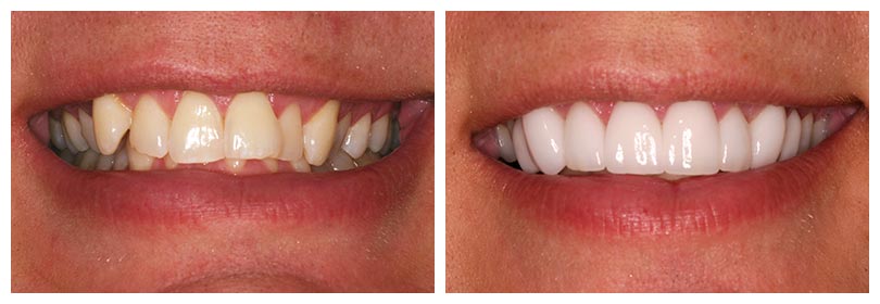 cerec dental crowns