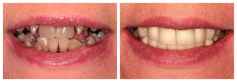 dental bridge restoration