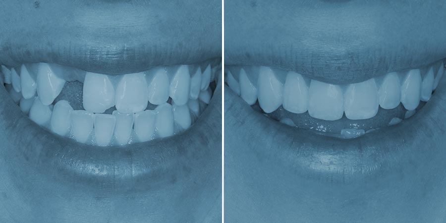 dental implant photos