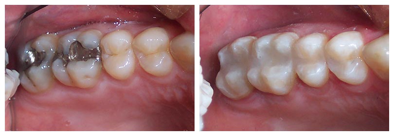 composite fillings